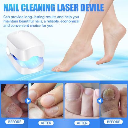 Rechargeable Nail Fungus Laser – Anti-Fungal Device Toenails, Hands & Feet (Home Use) signaturekarts
