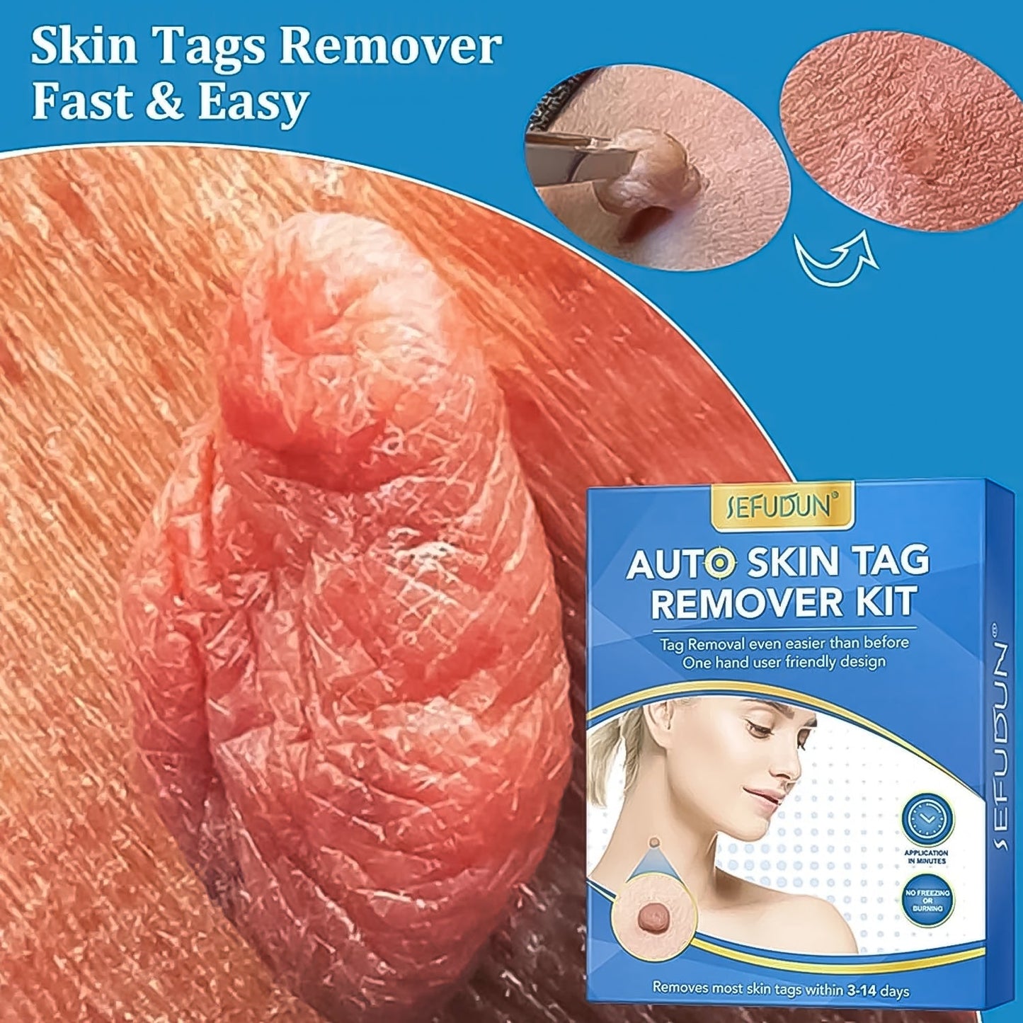 Skin Tag Remover Kit 2 in 1 for Micro to Large (2 mm - 8 mm / 1 Set) Signaturekarts