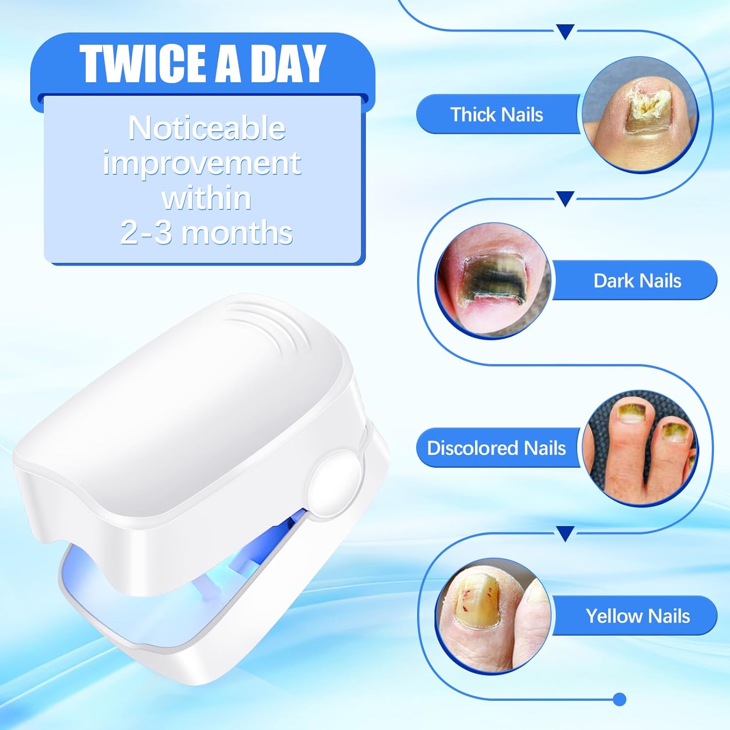Rechargeable Nail Fungus Laser – Anti-Fungal Device Toenails, Hands & Feet (Home Use) signaturekarts