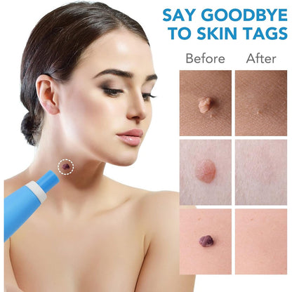 Skin Tag Remover Kit 2 in 1 for Micro to Large (2 mm - 8 mm / 1 Set) Signaturekarts