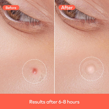 Pimple Patches for Face (1 Sheet Set) Signaturekarts